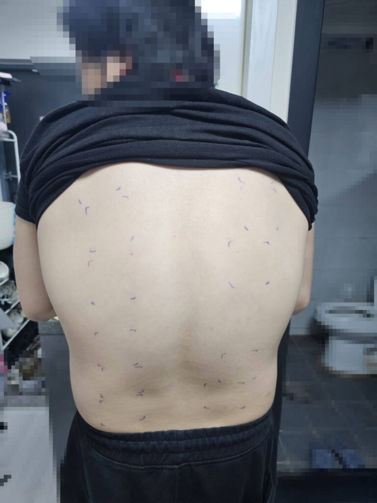 피엔케이피부임상연구센타 피부임상시험 후기 - 자외선 SPF 내수성 시험, 세후 23만 원 알바? (1탄: 1~2일차) 1일차 등