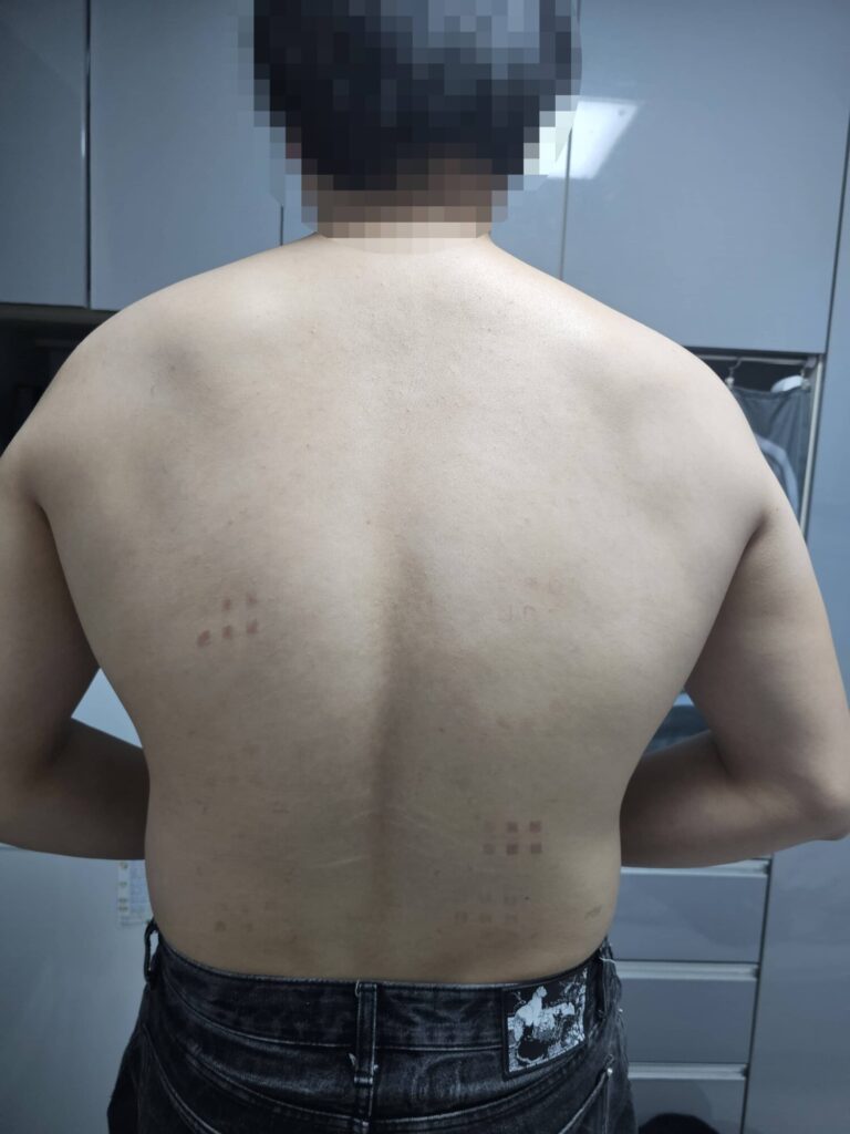 피엔케이피부임상연구센타 피부임상시험 후기 - 자외선 SPF 내수성 시험, 다시 돌아간다면 안 한다? (2탄: 3~4일차) 마지막 날 흉터